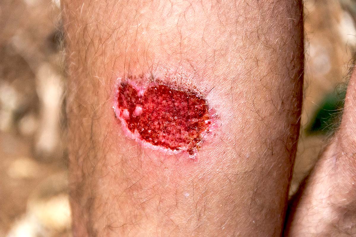 Severe motorcycle leg burn